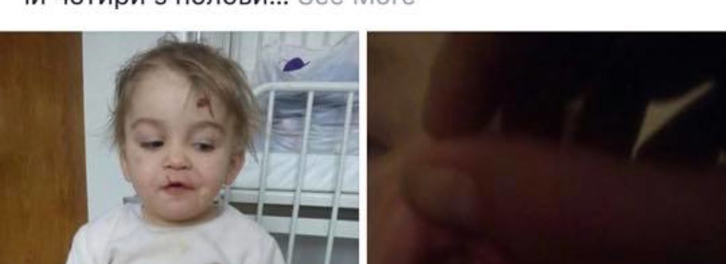 На Сколівщині мати довела 4-річну доньку до лікарні