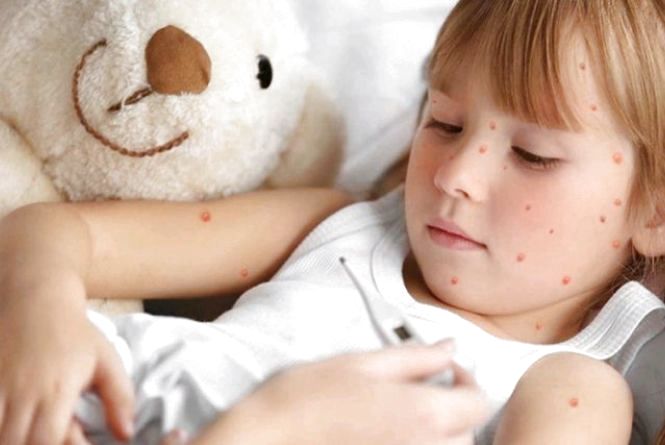 Медики зареєстрували 16 спалахів кору школах на Львівщині