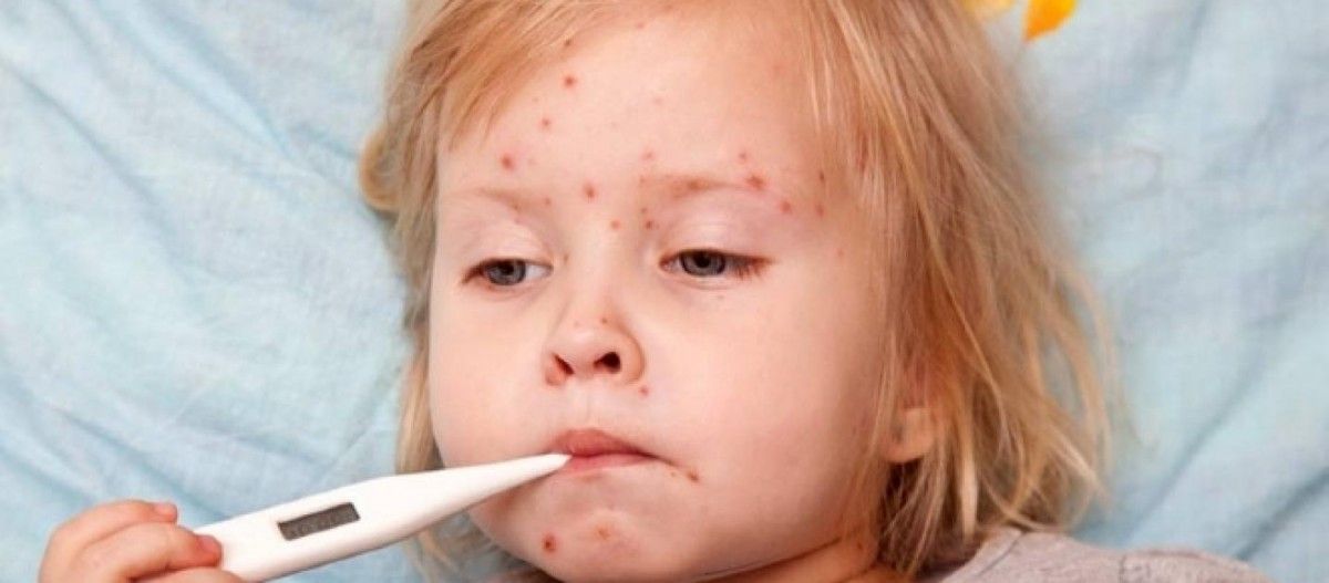 На Львівщині за тиждень ще 625 людей захворіло на кір