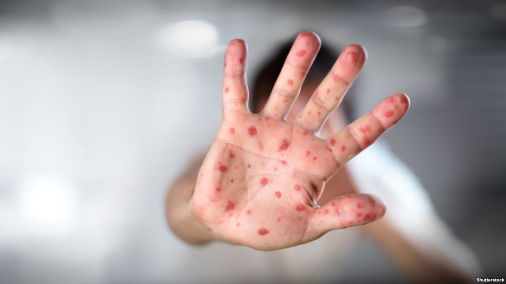 “Ті, хто померли від кору, не були вакцинованими”, – Наталія Тімко