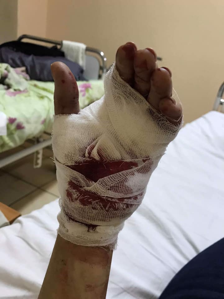 У Львові дівчині порізали обличчя через сумочку