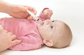 Четверо дітей на Львівщині через кір потрапили в реанімацію