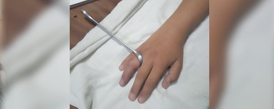 На Миколаївщині підліток запхав палець в автомобільний ключ: викликали рятувальників