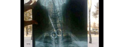 “Замотав ножиці у целофановий мішечок і проковтнув”: самбірські лікарі провели складну операцію