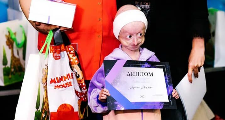 Уночі не стало єдиної в Україні дитини зі синдромом передчасного старіння