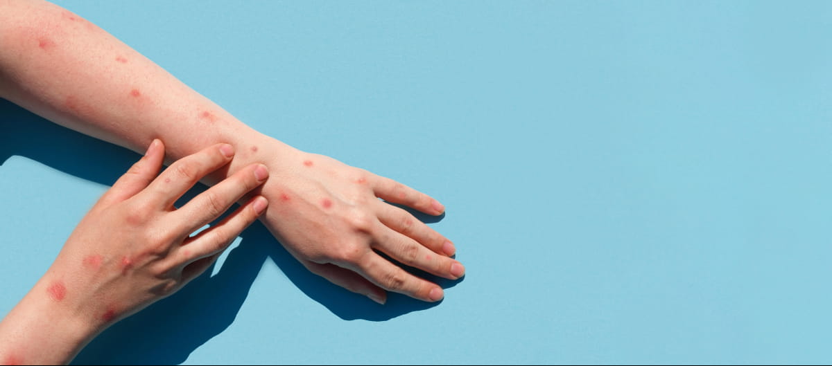 В Україні виявили другий випадок віспи мавп