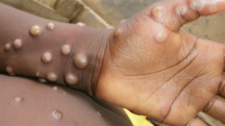 Вже третій: в Україні зафіксували новий випадок віспи мавп