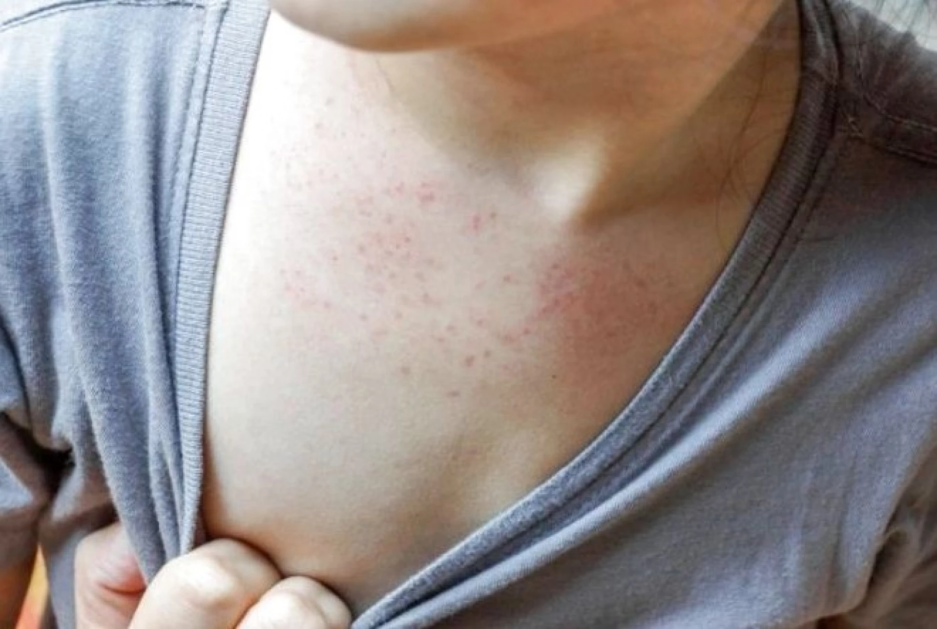 На Львівщині вперше цього року зафіксували випадок інфікування кором