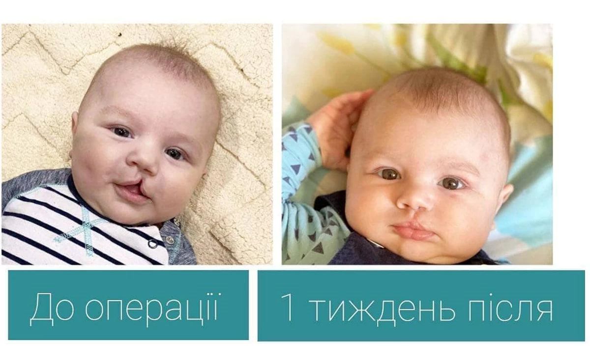У Львові 3-місячному Демʼяну прооперували “заячу” губу