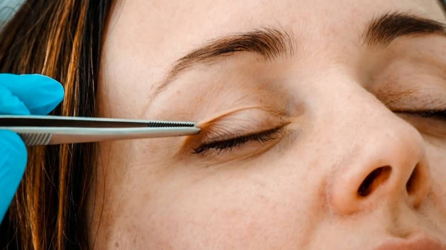 В одній з лікарень Львова у 24-річної пацієнтки з ока дістали 14-сантиметрового гельмінта