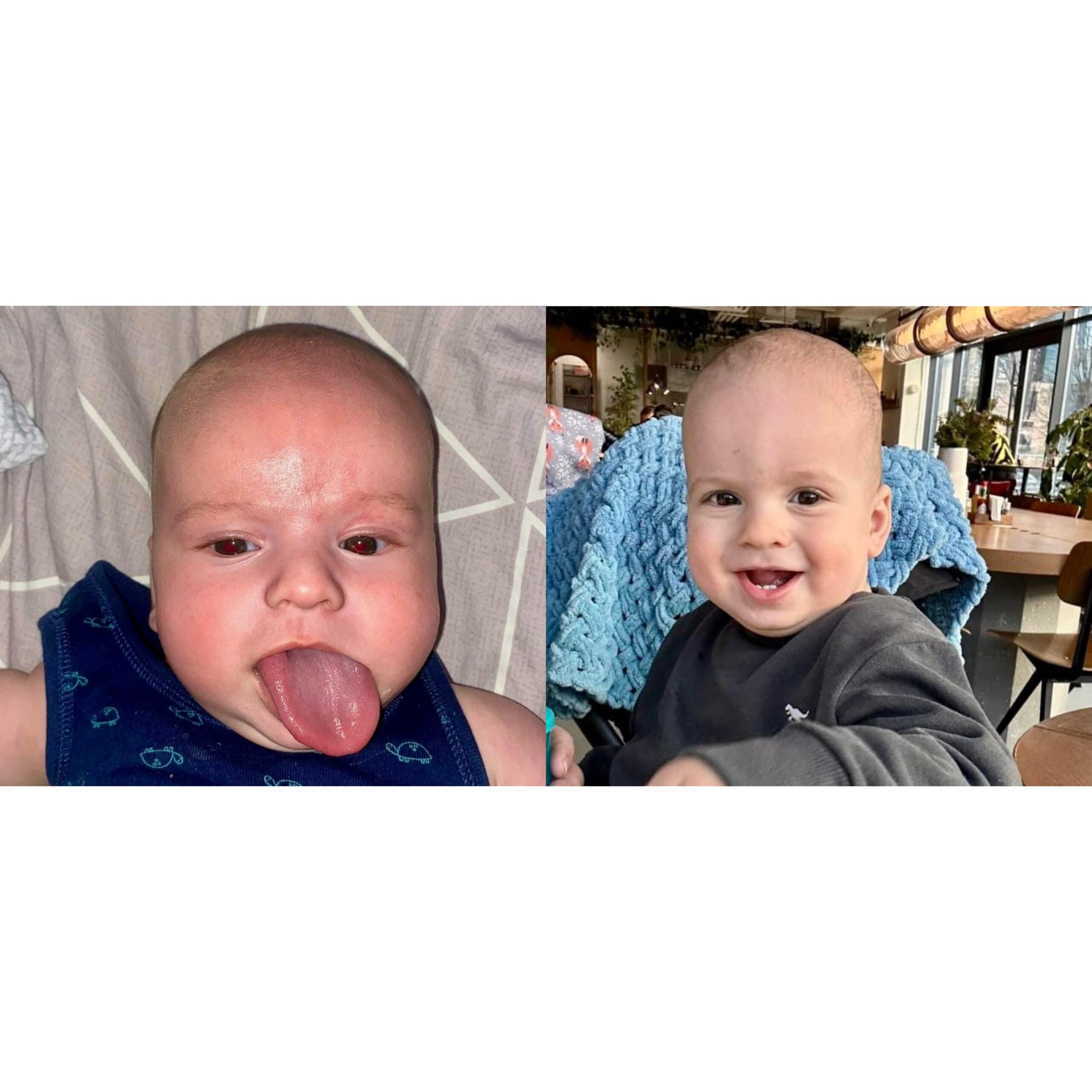 Львівські та американські хірурги прооперували малюка, який народився з величезним язиком