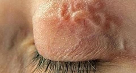 У Львові медики витягнули з ока чоловіка 11-сантиметрового паразита