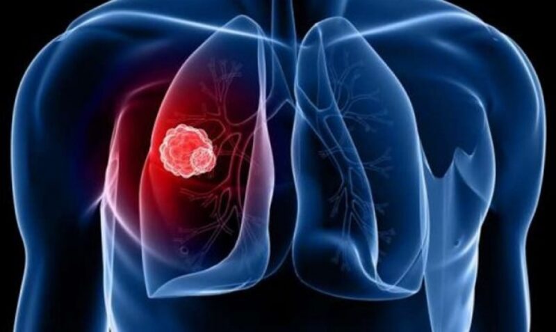 Львівщина посіла третє місце в Україні за рівнем туберкульозу