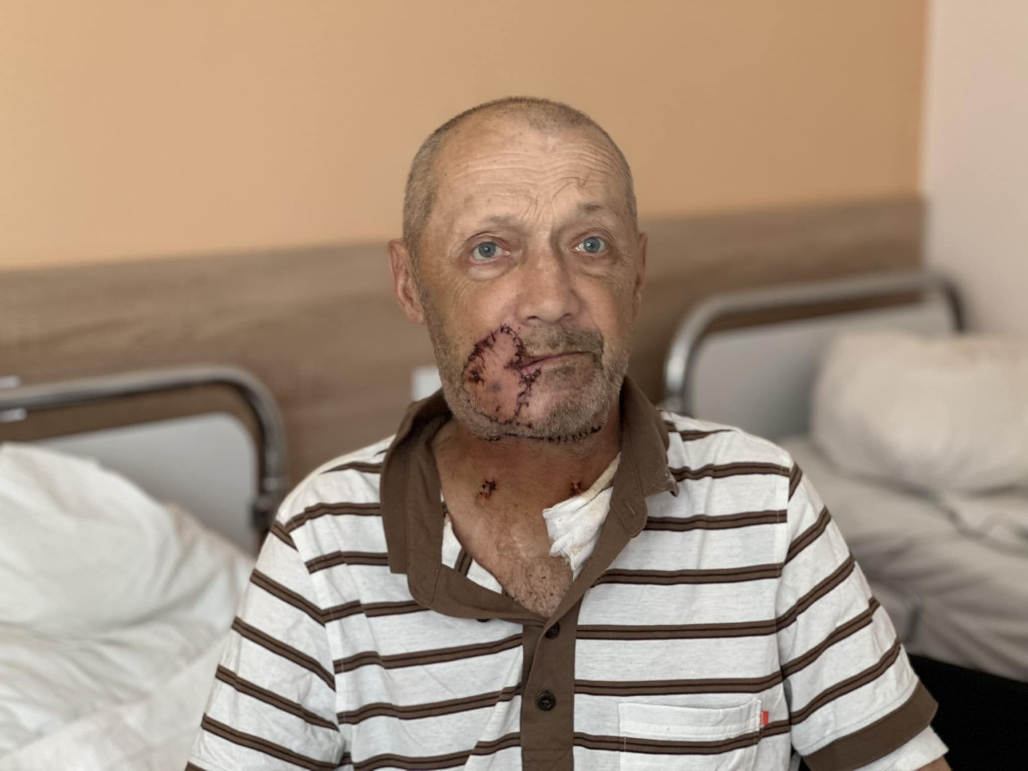 Відгриз шматок щоки: у Золочеві на чоловіка напав безпритульний собака