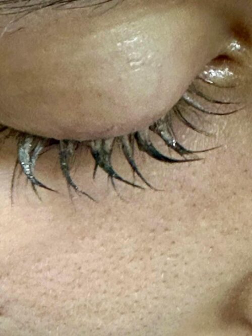 Штучні вії спричинили випадіння природних: у львівському «Охматдиті» допомогли 17-річній дівчині