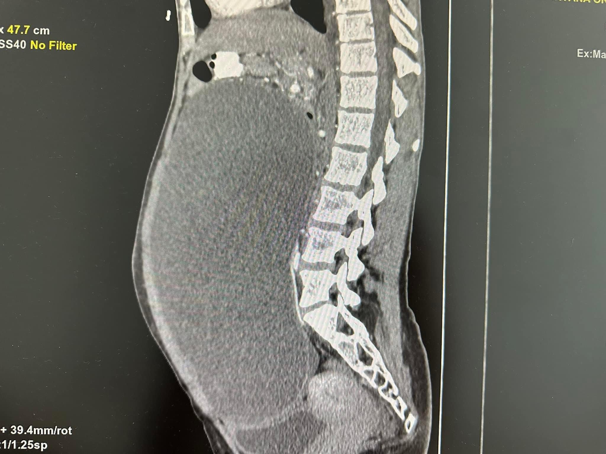 У Львові 28-річний жінці видалили гігантську пухлину з 9-ма літрами рідини всередині