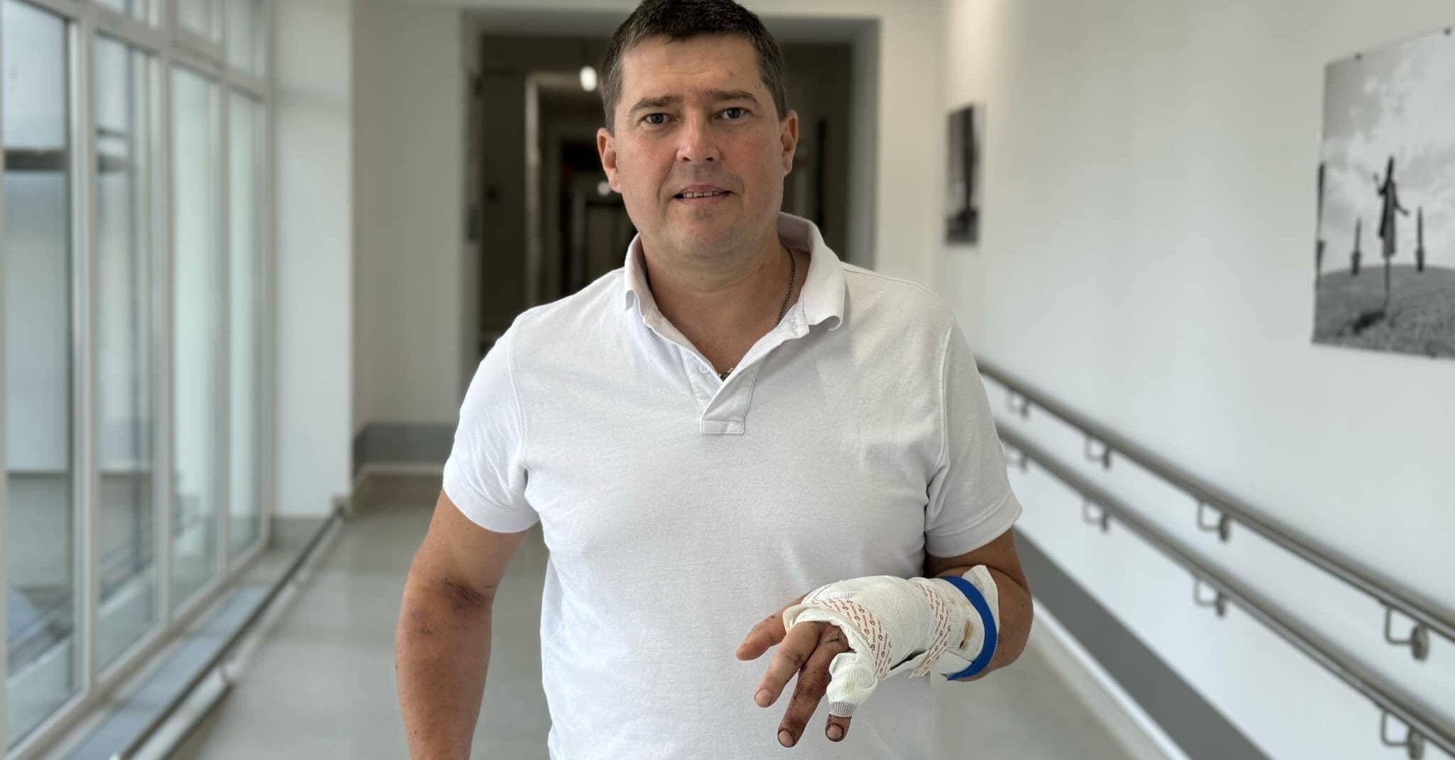 Дрон розірвався лише у пів метрі від чоловіка: львівські хірурги виконали складну операцію, щоб врятувати пальці Захисника