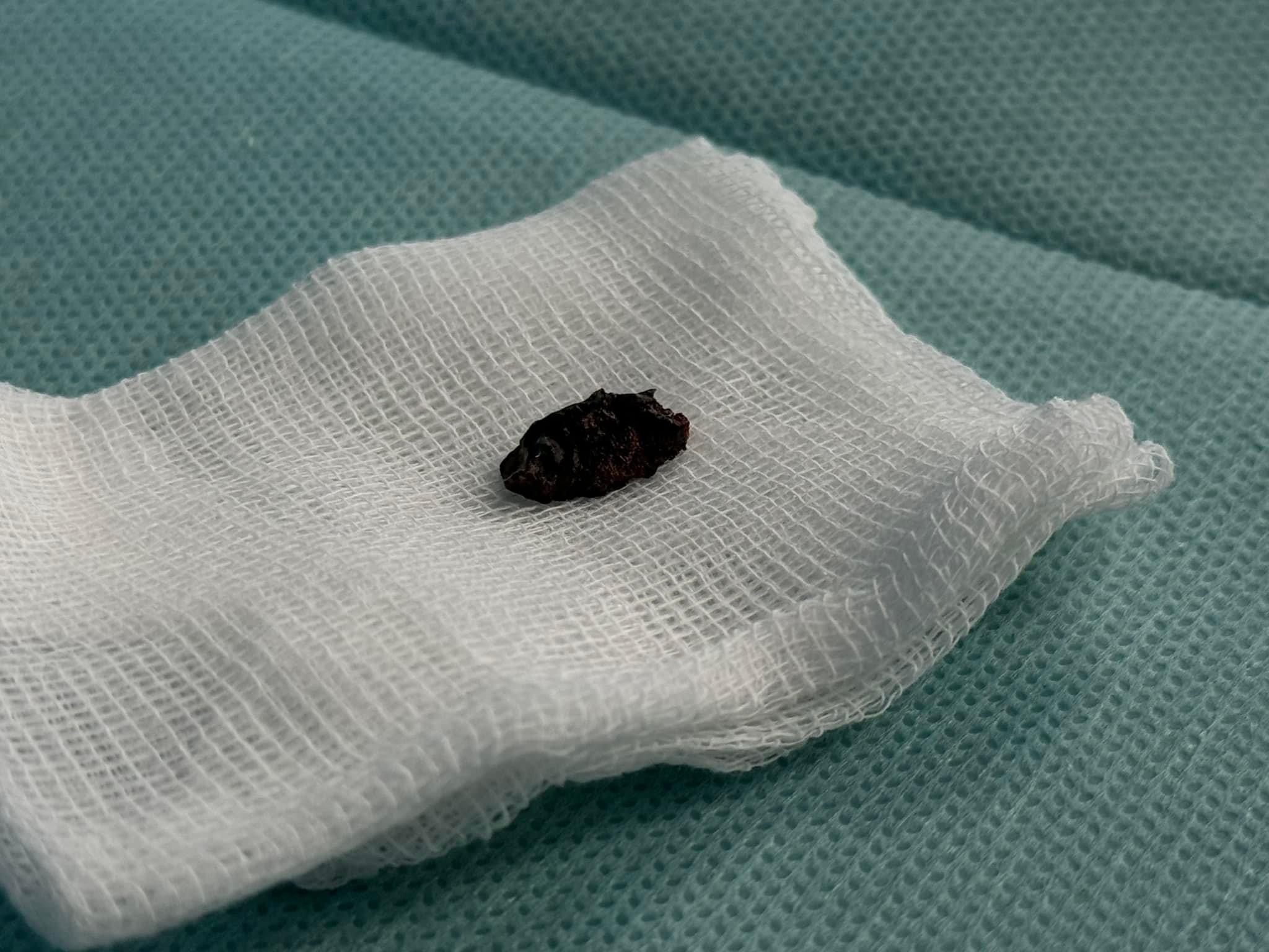 Львівʼянку, якій під час атаки на місто потрапив уламок в серце, виписали з лікарні