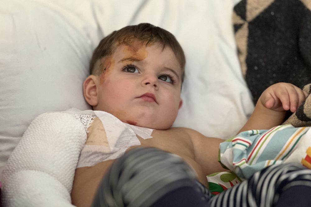 Львівські медики врятували півторарічного хлопчика зі Стрия, який отримав сильні опіки