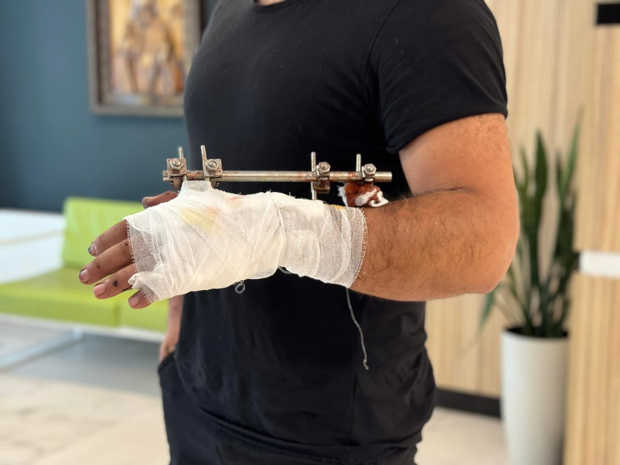 Хірурги Львова врятували чоловіку руку, що трималася на клаптику шкіри