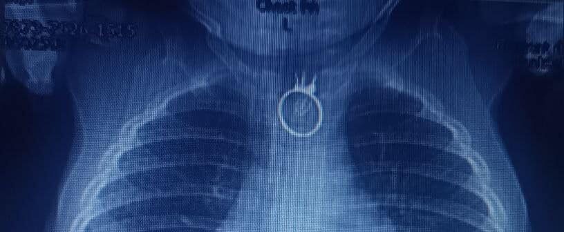 Львівські хірурги успішно провели операцію малюку, який проковтнув іграшковий перстень