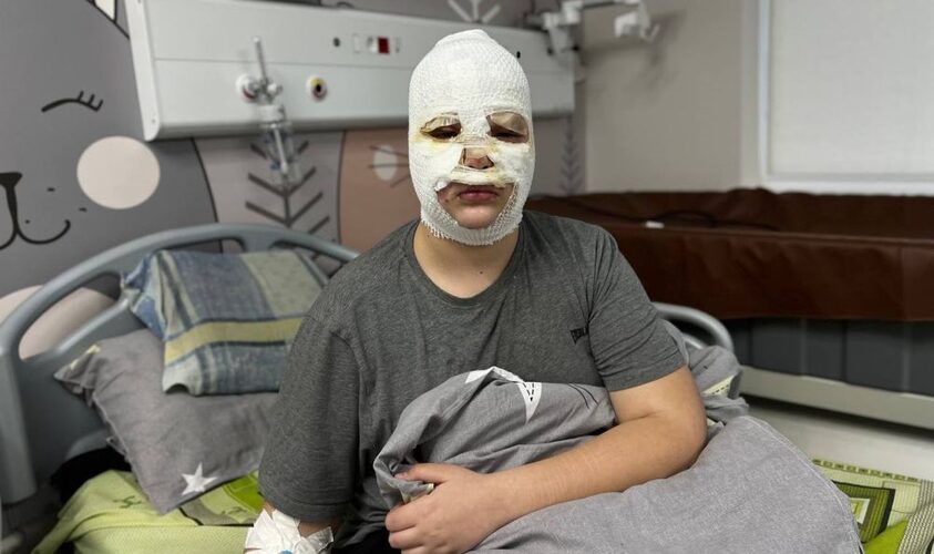 Через нову пошесть із Тік-Току діти роблять «петарду» і отримують глибокі опіки обличчя