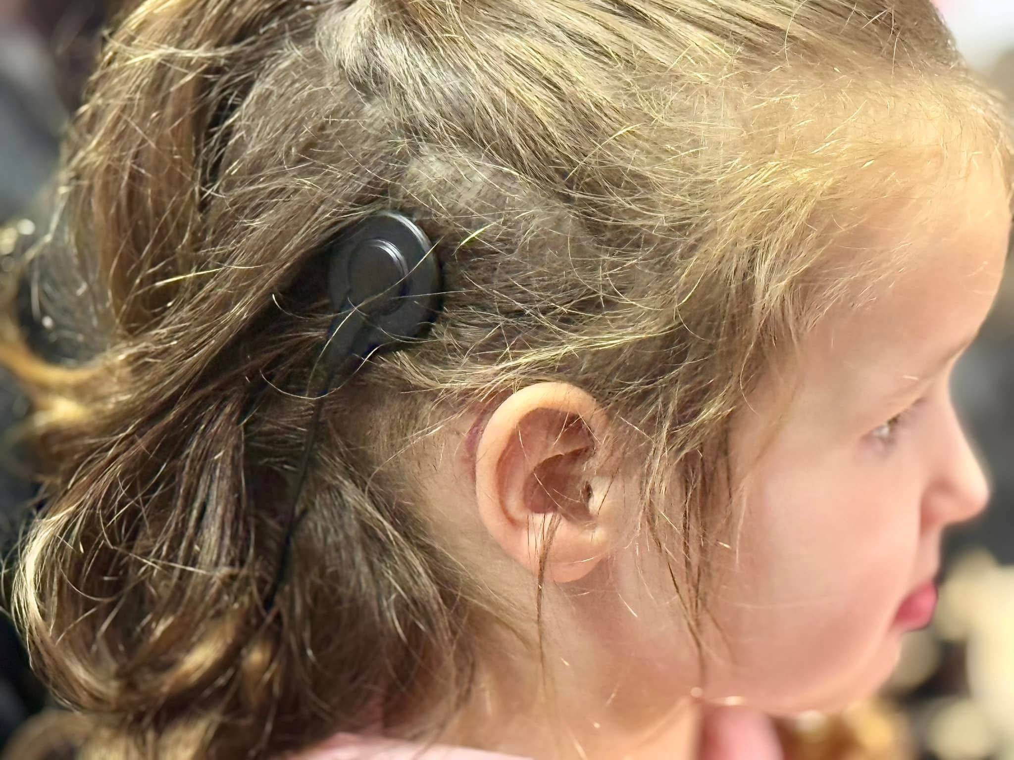 Перші звуки у житті: у Львові дітям із вадами слуху підключили кохлеарні імпланти