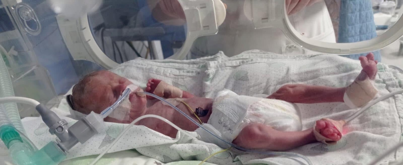 В Львівському перинатальному центрі виходили малюка, народженого з вагою 890 грамів
