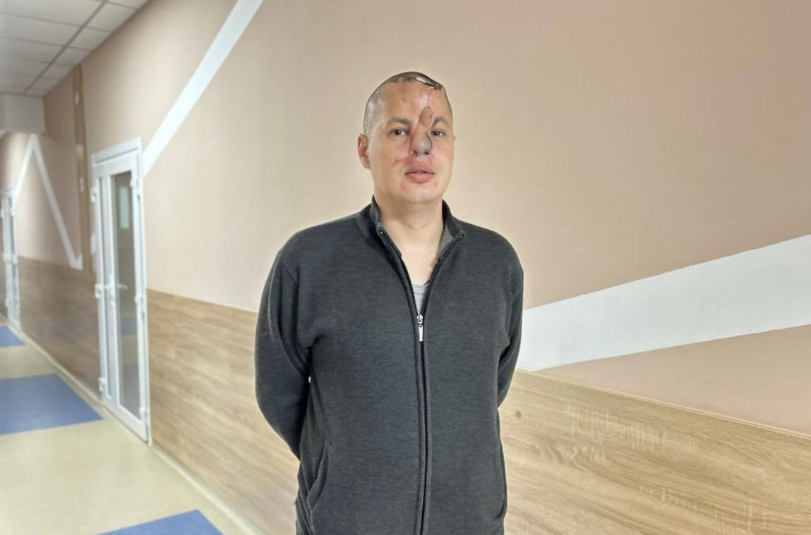 У центрі UNBROKEN воїну реконструювали повністю зрізаний уламками ніс