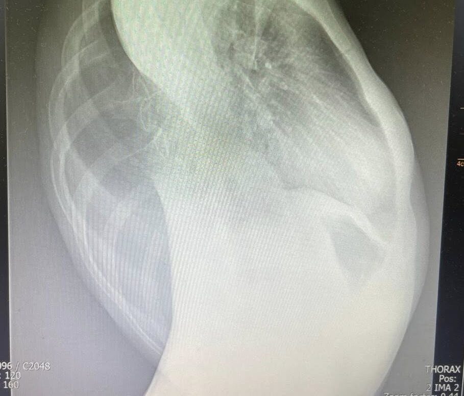 У 13-річної дівчинки з Львівщини сколіоз «маскувався» під пневмонію