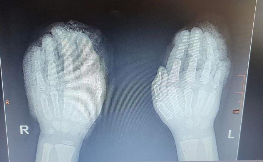 Львівські лікарі врятували руки 5-річному хлопчику після страшної травми в січкарні (ФОТО)