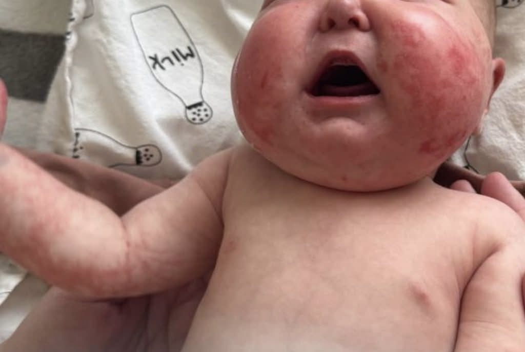 Дві рідкісні хвороби у немовляти