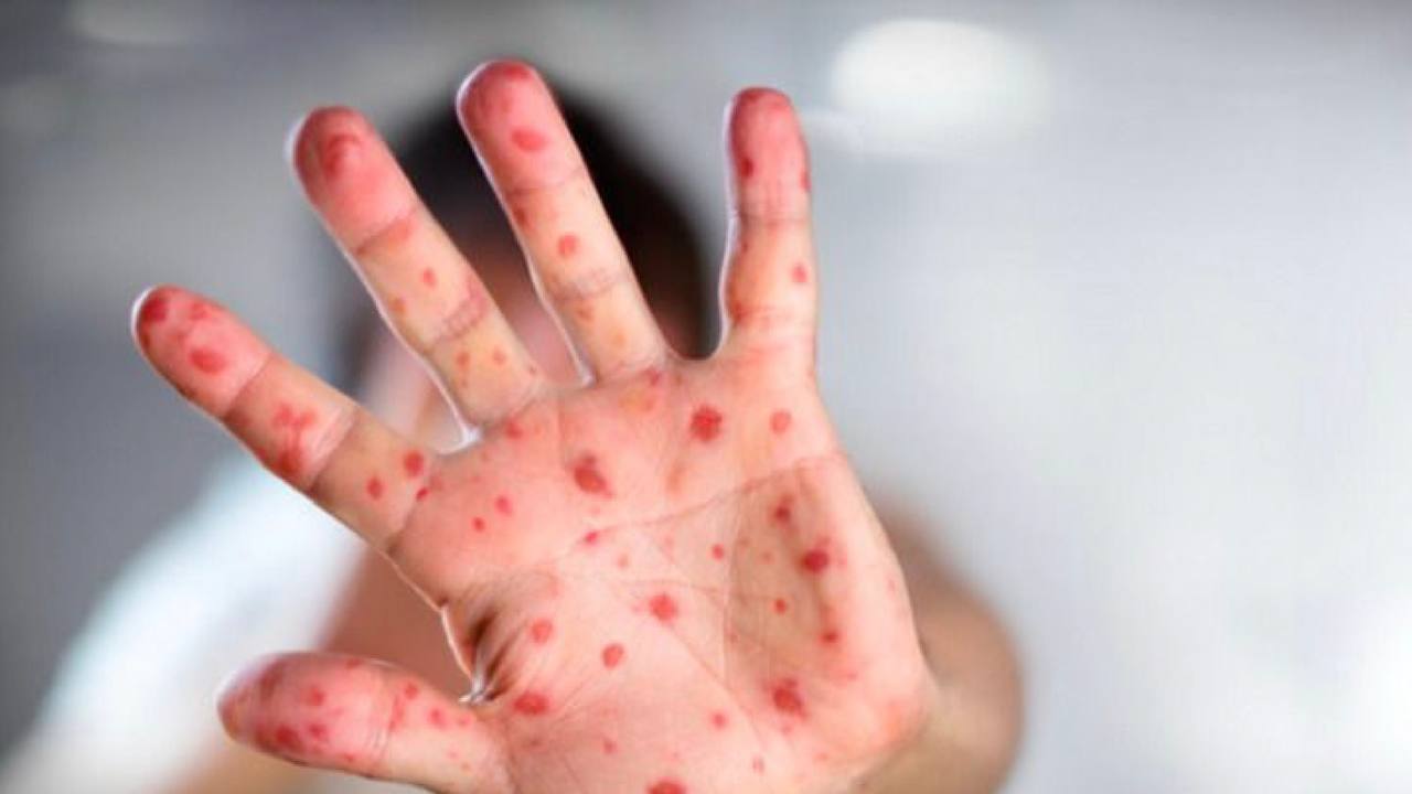 Захворюваність на кір зросла у дев’ять разів на Львівщині: лікарі радять робити щеплення