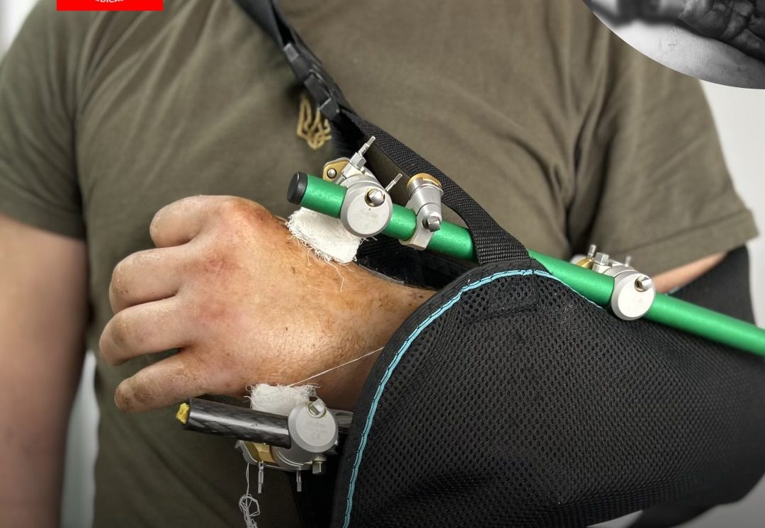 Львівські хірурги врятували руку чоловікові після майже повної ампутації бензопилою